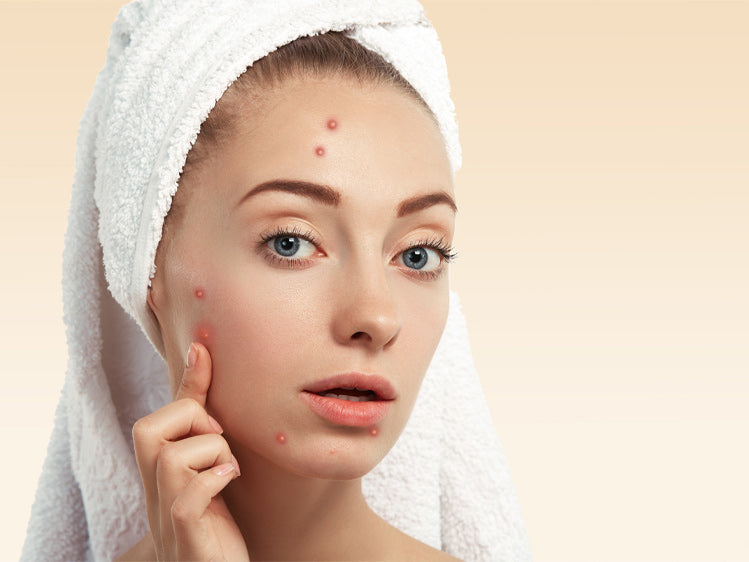 Does Red Light Therapy Help Acne?