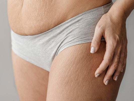 The Role of Red Light Therapy for Stretch Marks and Scars